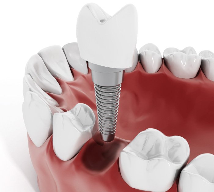 Precios implantes dentales